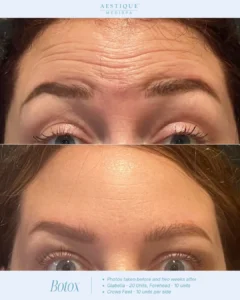 a woman's face with wrinkles, Botox in Pennsylvania