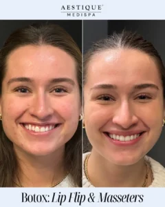 a woman smiling and a comparison of her face, Botox: Lip Flip & Masseters in Pennsylvania