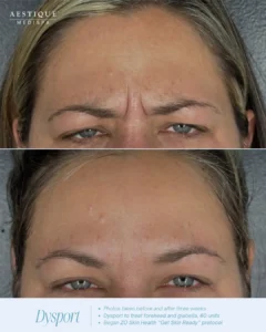 a woman's face with wrinkles, Dysport in Pennsylvania