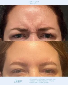 A woman's face with wrinkles. Botox in Pennsylvania