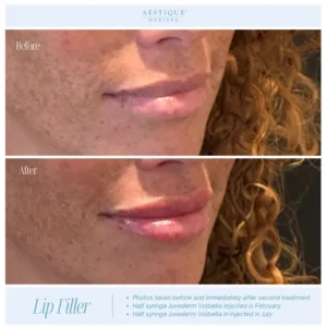 A woman's face with wrinkles. Botox in Pennsylvania