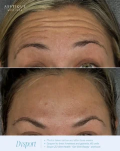 a woman's face with wrinkles, Dysport in Pennsylvania