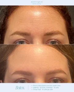 a woman's face with a comparison of her eyebrows, Botox in Pennsylvania