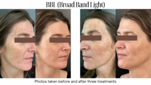 Aestique Medispa before and after