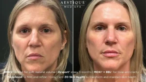 Aestique Medispa before and after