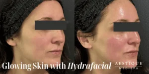 Aestique Medispa before and after