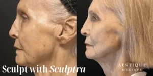 Aestique Medispa before and after
