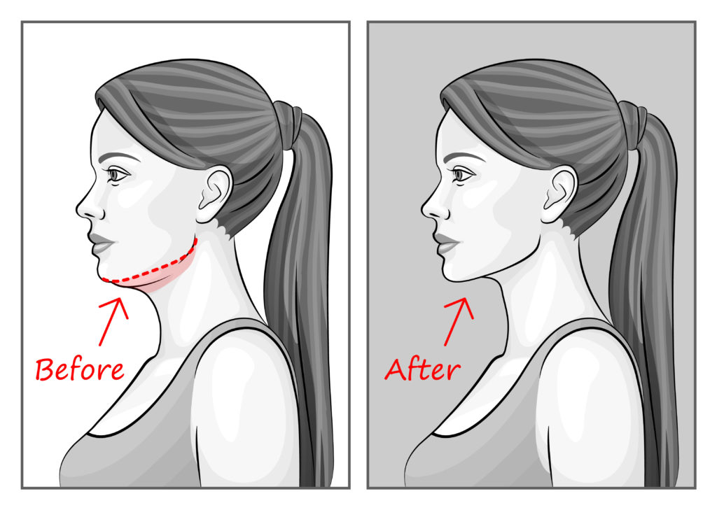 Can Kybella Melt Fat?