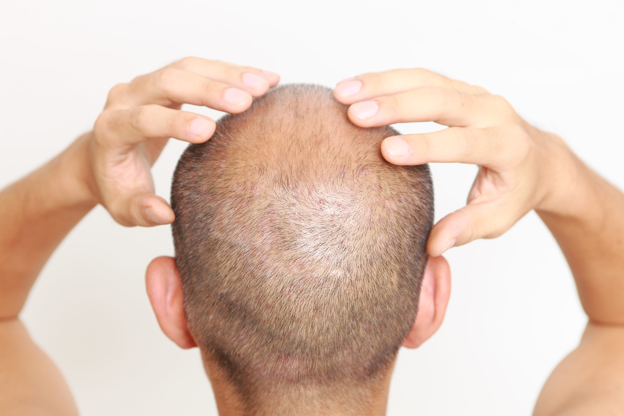 How Does The Hair Restoration Process Work