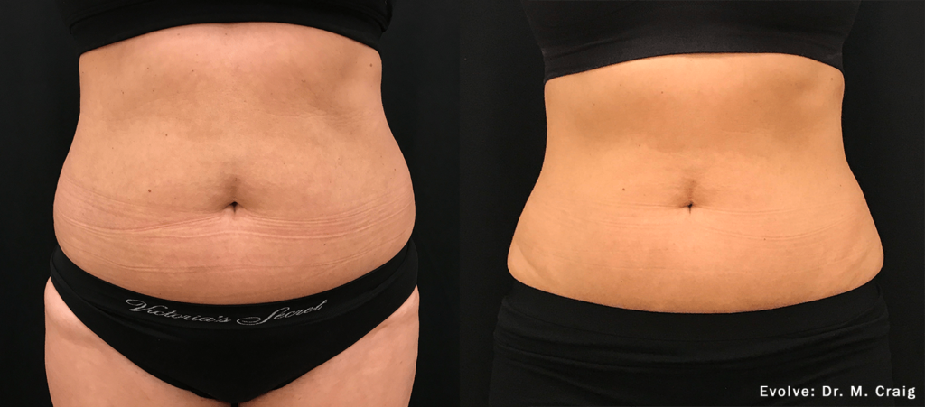 Evolvex 7 Evolve Abdomen